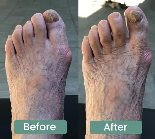 Bunion Align - Natural At-Home Bunion Relief